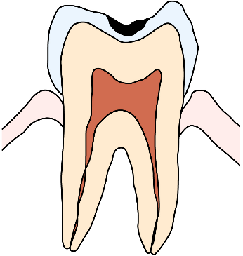 初期の虫歯